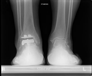Radiograph after implantation